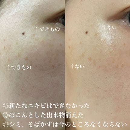 薬用しみ集中対策 プレミアム美容液/メラノCC/美容液を使ったクチコミ(3枚目)