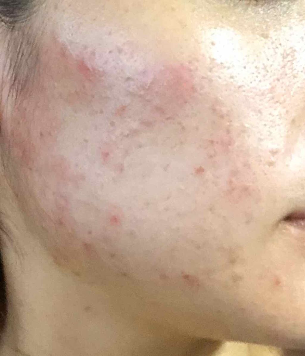 Bella on LIPS 「顎ニキビが1つあり、皮膚科の先生からよく効くよ!との事でデュア..」(1枚目)