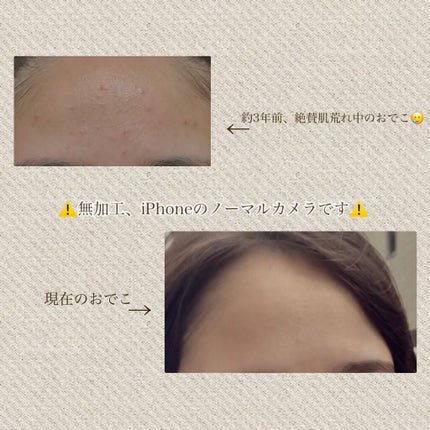 ハトムギ化粧水(ナチュリエ スキンコンディショナー R )/ナチュリエ/化粧水を使ったクチコミ(6枚目)