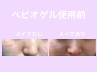 くろこ on LIPS 「こんにちは🦋ベピオゲルの経過報告です！1週間で赤みがぶわーっと..」（1枚目）