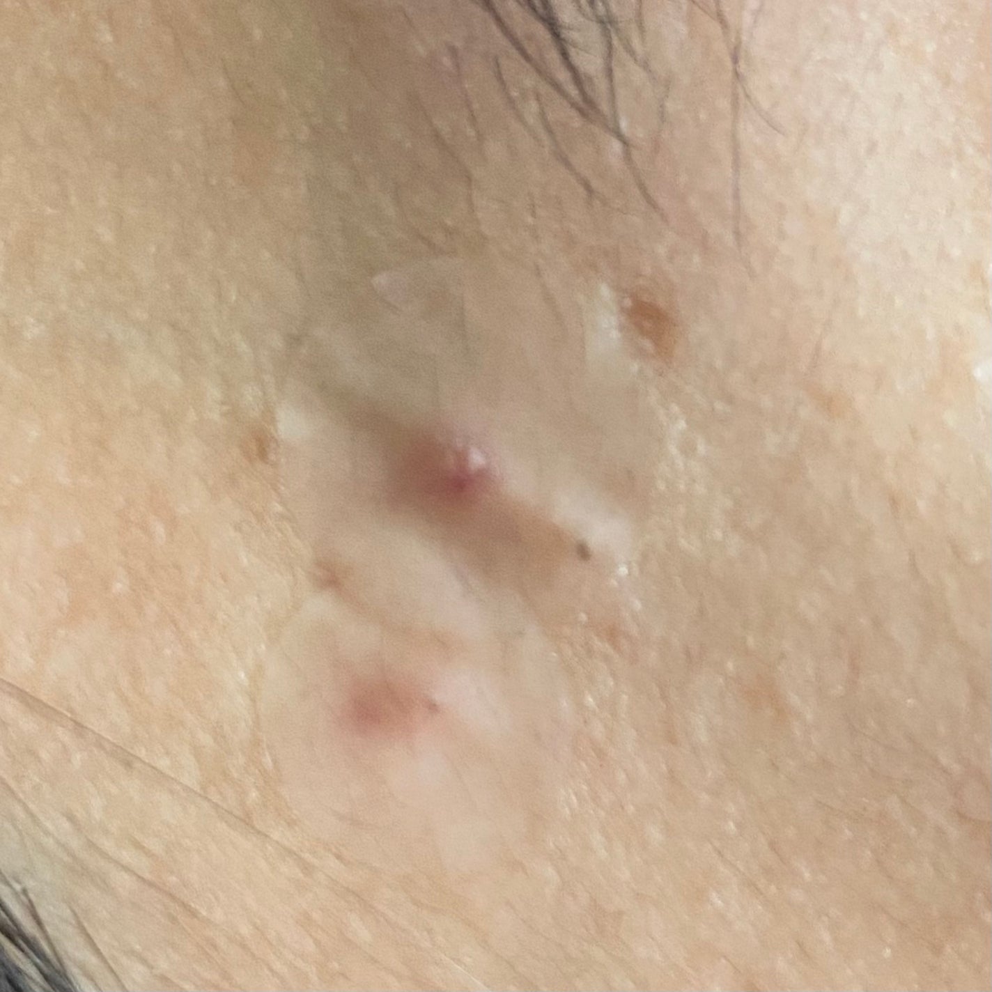 極薄透明パッチ nikipa!/金冠堂/にきびパッチを使ったクチコミ(3枚目)