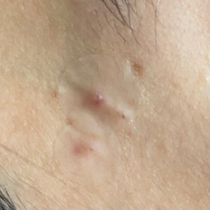 極薄透明パッチ nikipa!/金冠堂/にきびパッチを使ったクチコミ(3枚目)