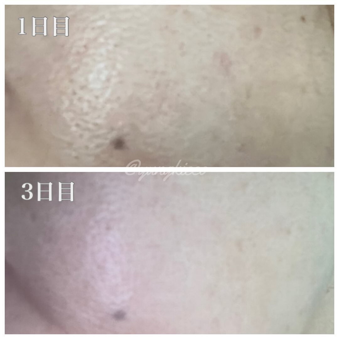 リードルS 100 2ステップマスク/VT/シートマスク・パックを使ったクチコミ(5枚目)