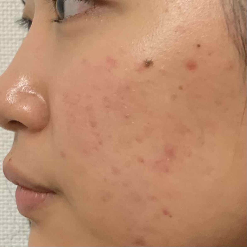 クリアモイスチャー M（しっとりタイプ）/オルビス/乳液を使ったクチコミ（1枚目）