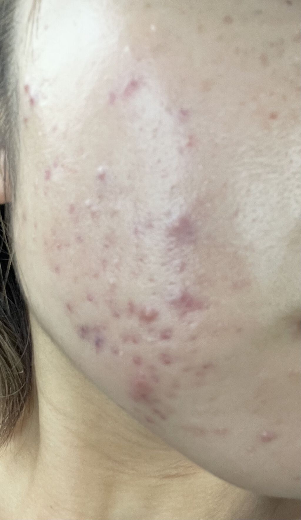 オードムーゲ 薬用ローション（ふきとり化粧水）/オードムーゲ/拭き取り化粧水を使ったクチコミ（1枚目）