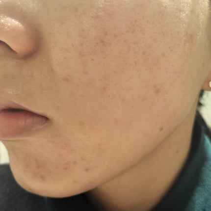 miina@汚肌工事録⚠️ on LIPS 「2023/06/25の#汚肌工事録次の日は#血みどろピーリング..」(2枚目)