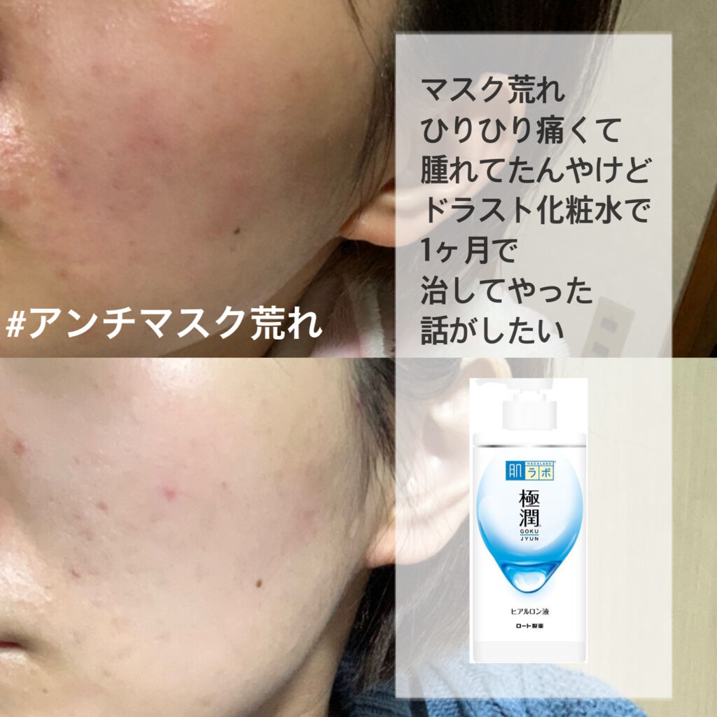 極潤ヒアルロン液（ハダラボモイスト化粧水d）/肌ラボ/化粧水を使ったクチコミ（1枚目）