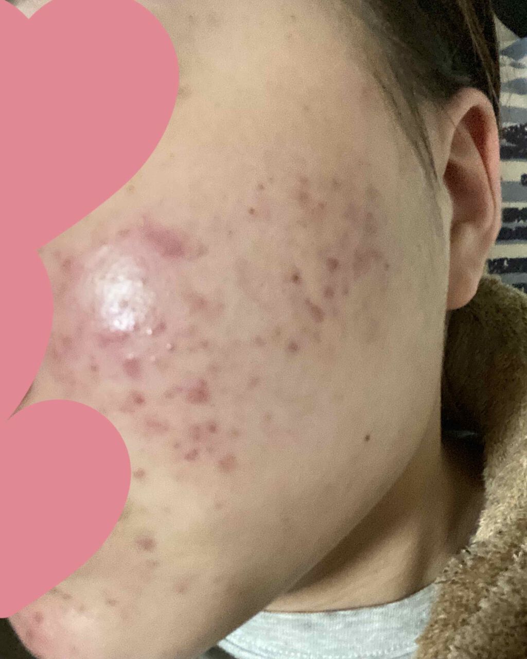 みみみみみ on LIPS 「助けてください!!!!!😭ニキビとニキビ跡と赤みがひどくて1年..」(1枚目)