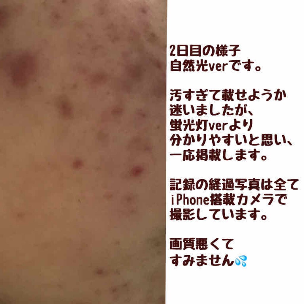 双海 on LIPS 「ニキビ治療期/皮膚科編⚡️Week1『皮膚科の先生助けてくださ..」(3枚目)