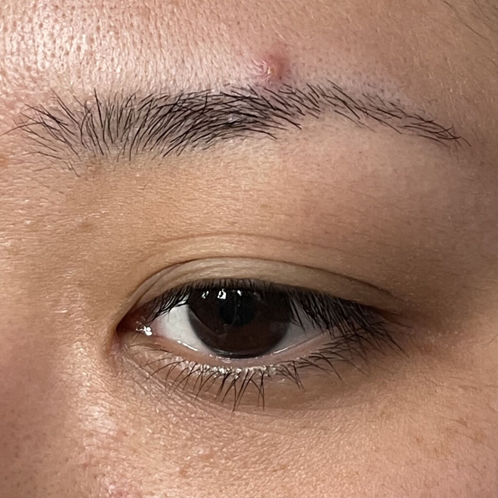 極薄透明パッチ nikipa!/金冠堂/にきびパッチを使ったクチコミ（3枚目）