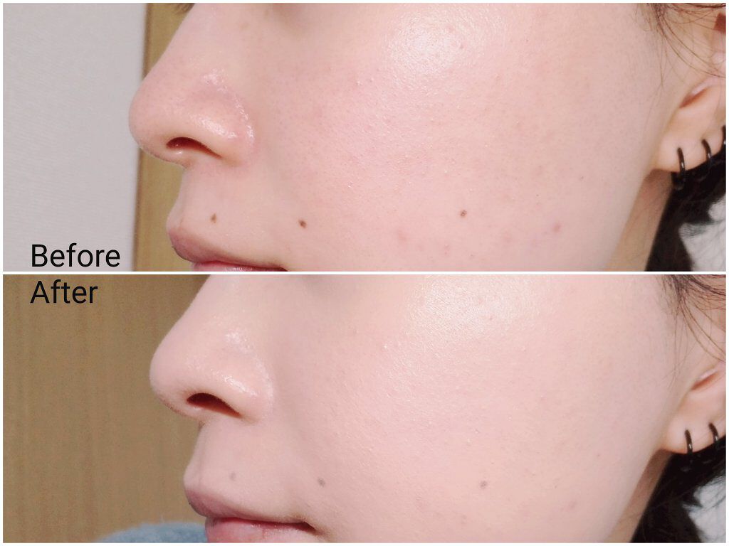 ピンクティーツリーカバークッション/APLIN/クッションファンデーションを使ったクチコミ(5枚目)