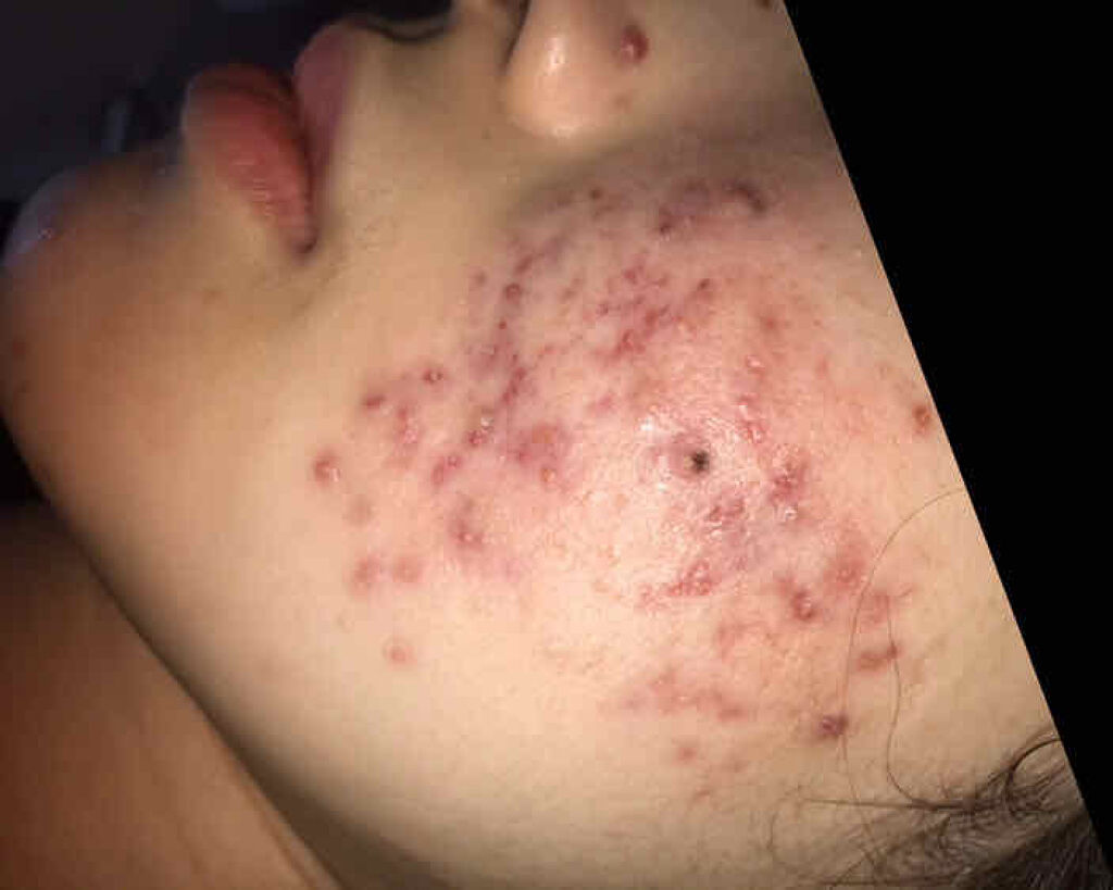 集中対策マスクMK　しっとり高保湿タイプ/メラノCC/シートマスク・パックを使ったクチコミ（2枚目）