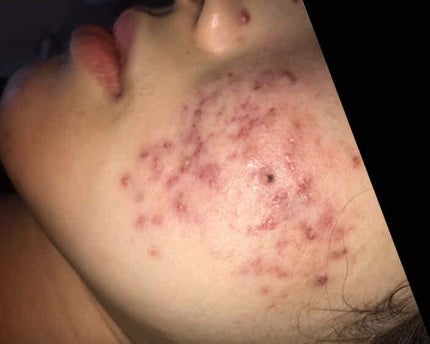 薬用3ステップセット30日サイズ/プロアクティブ/トライアルキットを使ったクチコミ(2枚目)