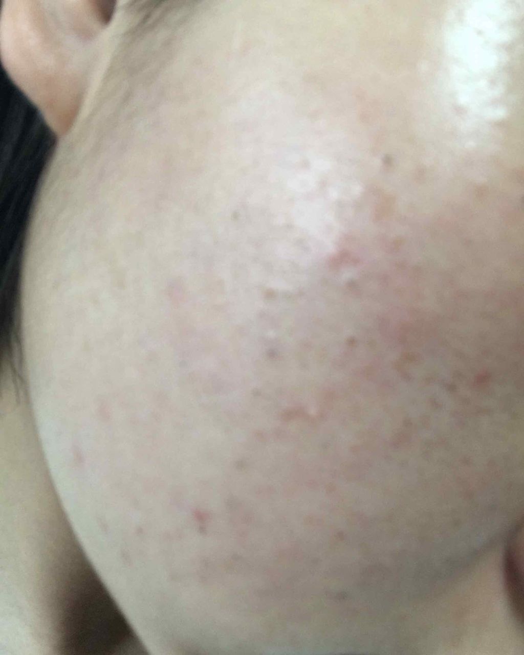 kira on LIPS 「絶賛肌荒れ時期ですこういう肌荒れの治し方わかる方コメントしてい..」(1枚目)