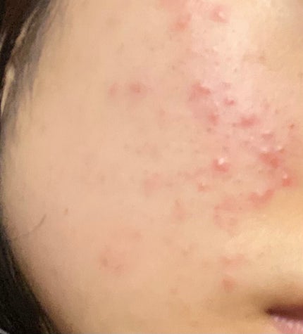 薬用しみ対策 美白化粧水/メラノCC/化粧水を使ったクチコミ(1枚目)