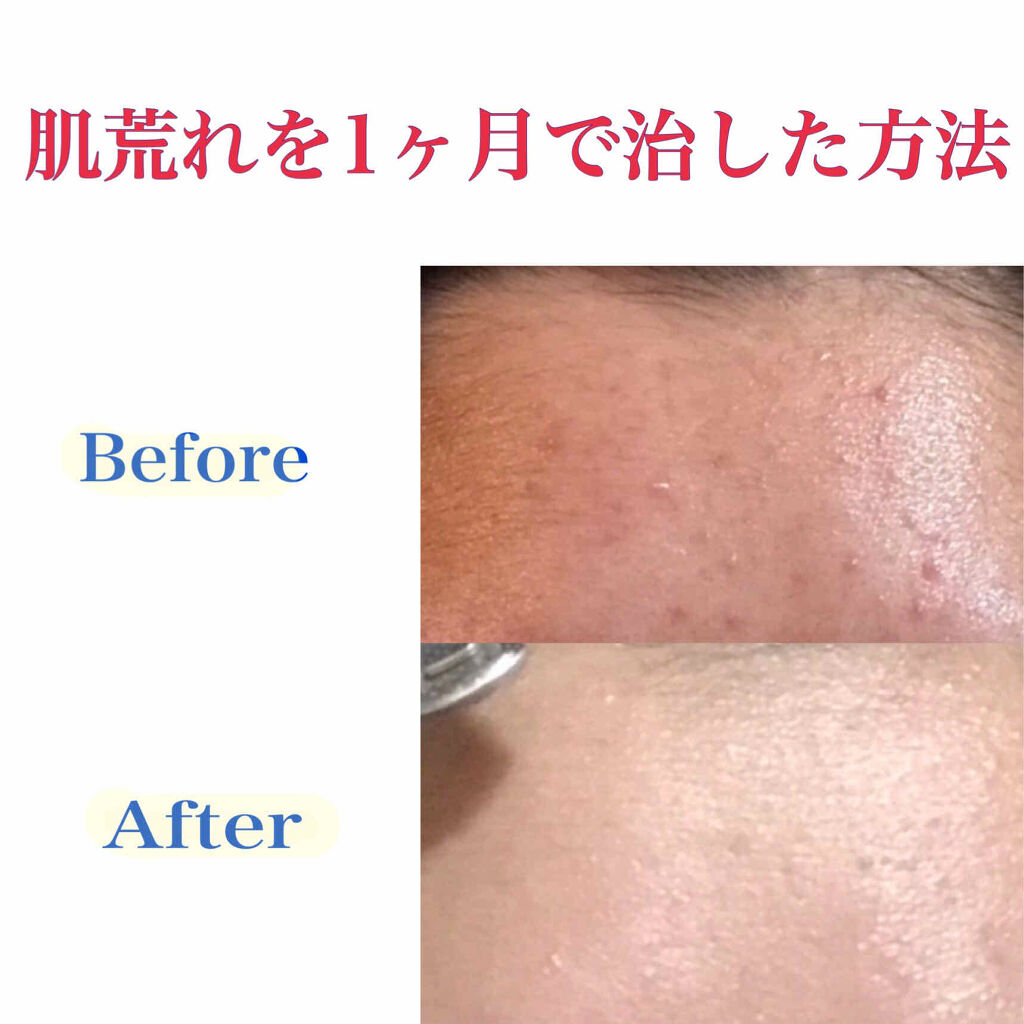 ペアアクネクリームW(医薬品)/ペア/その他を使ったクチコミ（1枚目）