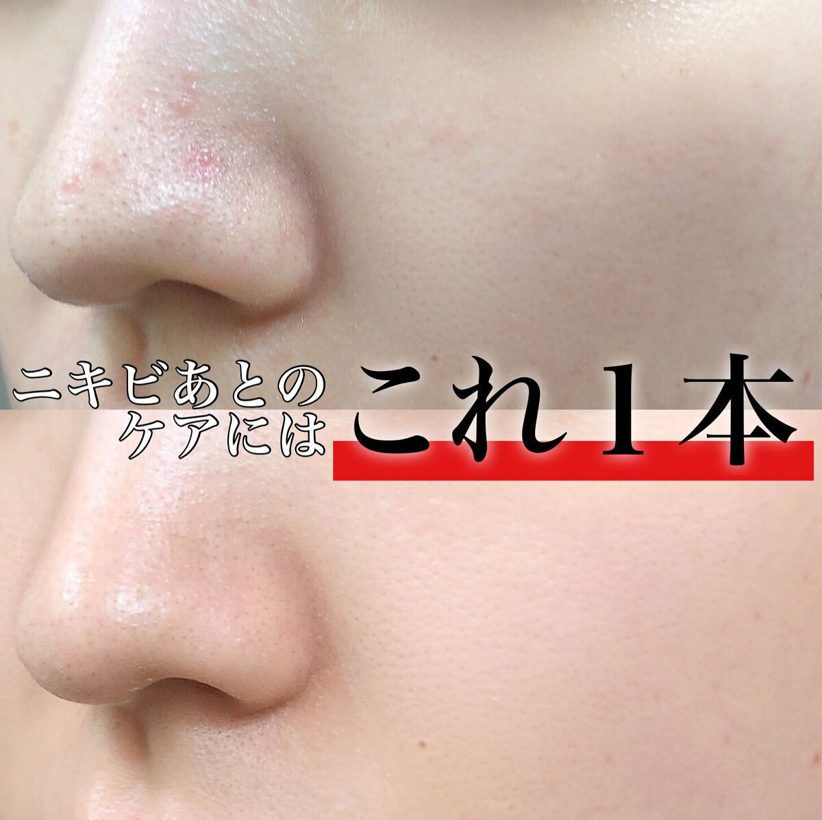 ニキビあとケアジェル/アットノン/その他スキンケアを使ったクチコミ（1枚目）