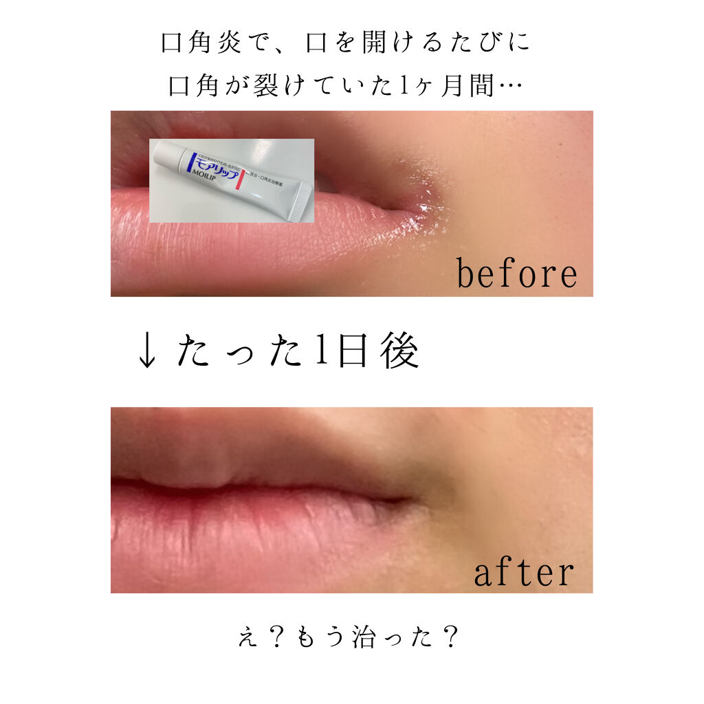 モアリップ N (医薬品)/資生堂薬品/その他を使ったクチコミ（2枚目）