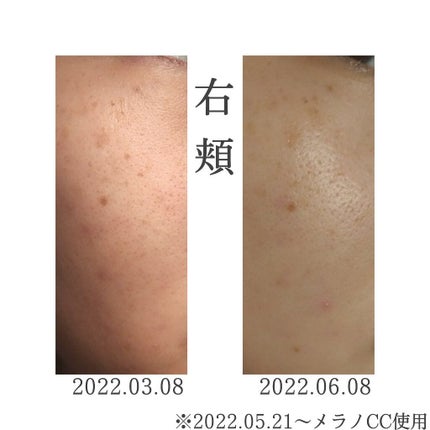 薬用しみ集中対策 プレミアム美容液/メラノCC/美容液を使ったクチコミ(6枚目)