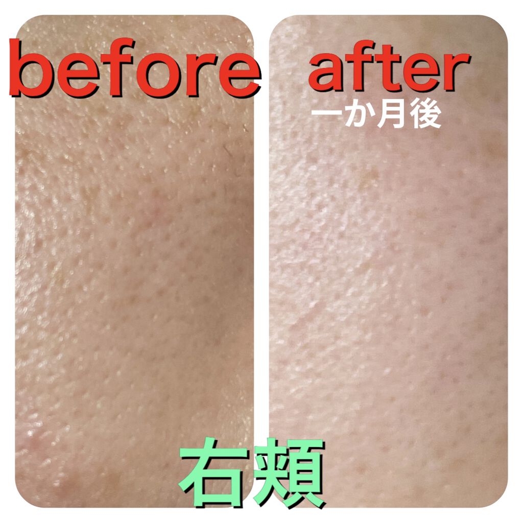 オバジC25セラムNEO/オバジ/美容液を使ったクチコミ（1枚目）