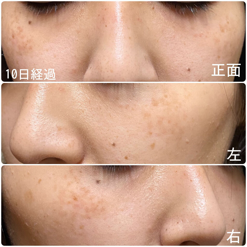 レチノールA 1% アドバンスドリバイタリゼーションクリーム/Life-flo/フェイスクリームを使ったクチコミ（3枚目）