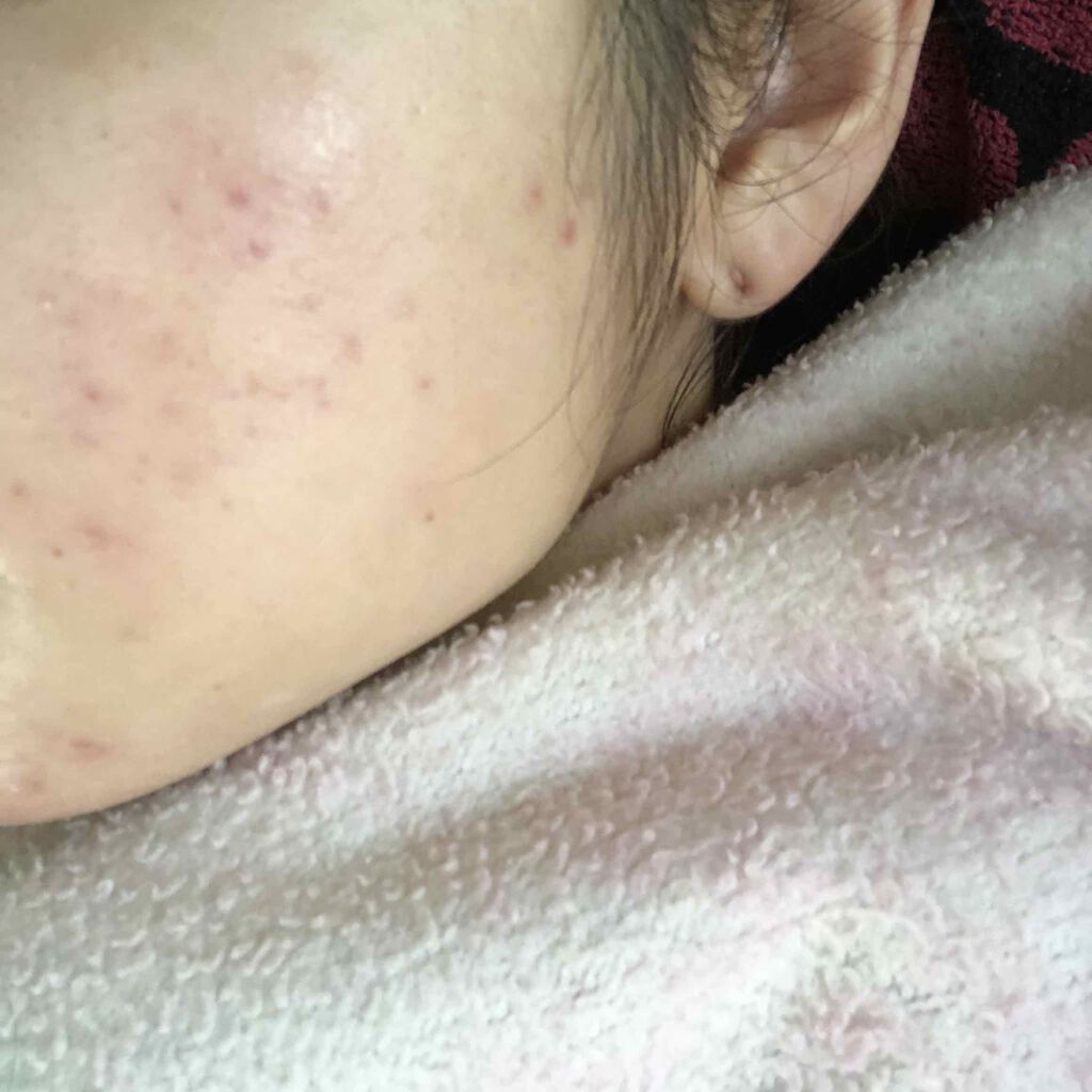 エピデュオゲル/マルホ株式会社/その他を使ったクチコミ（3枚目）