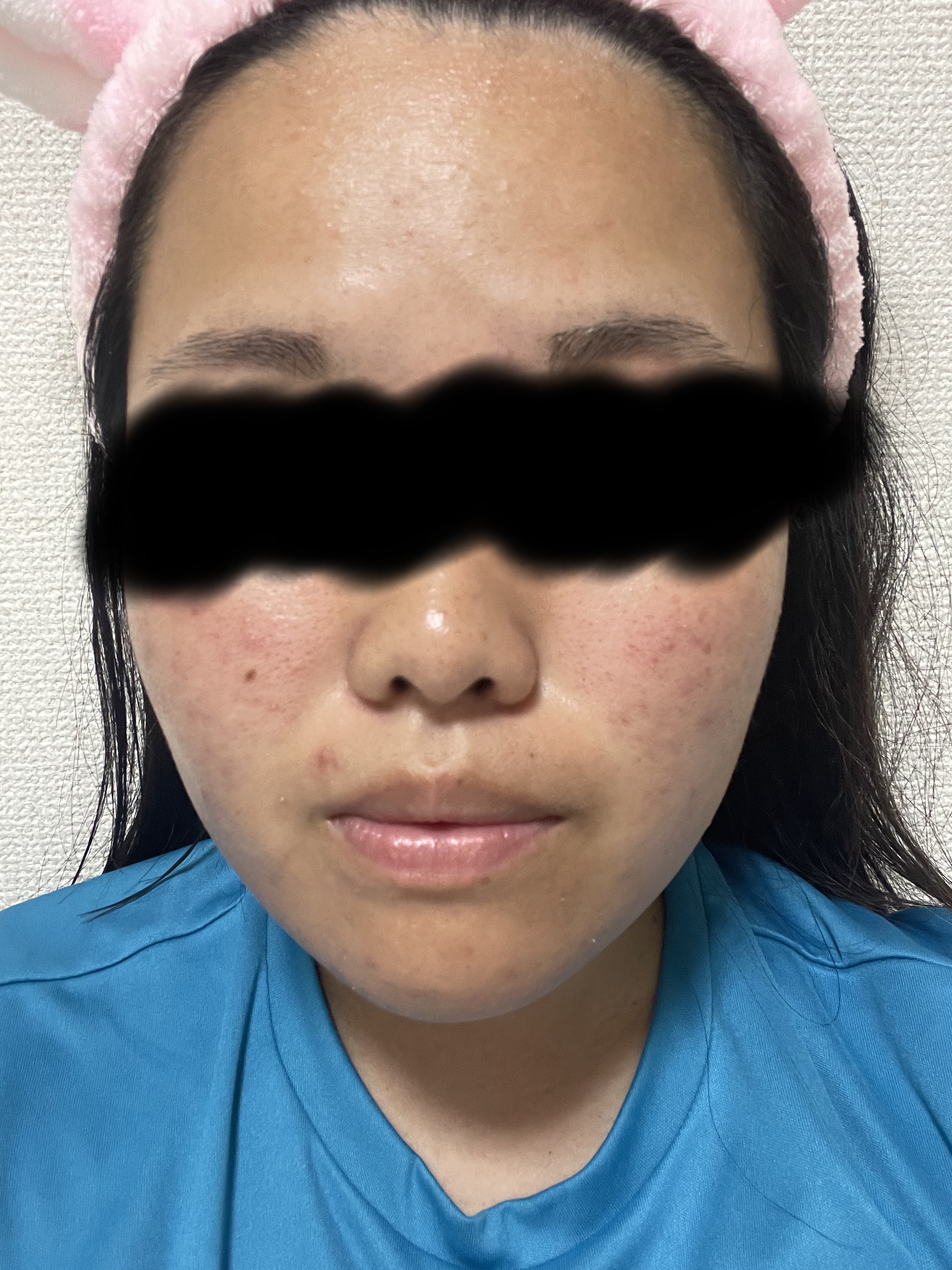 薬用 極潤 スキンコンディショナー/肌ラボ/化粧水を使ったクチコミ（2枚目）