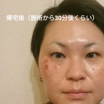 ビヨンセ奥二重向上委員長🥸LIPSパートナー🥳 on LIPS 「湘南美容クリニックでシミ取りレーザーしてきたよ!なんと3つで7..」(5枚目)