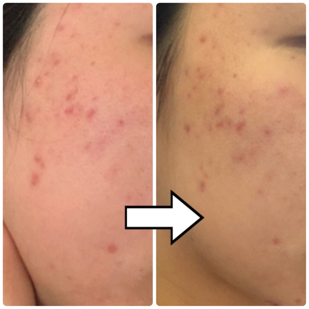 パーフェクショニスト プロ ブライト エッセンス アンピュール/ESTEE LAUDER/美容液を使ったクチコミ(2枚目)