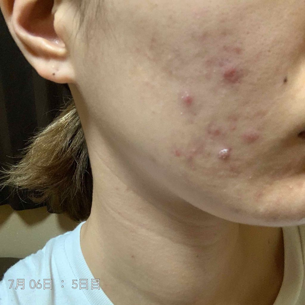 バランスケア ローション W II/d プログラム/化粧水を使ったクチコミ（3枚目）