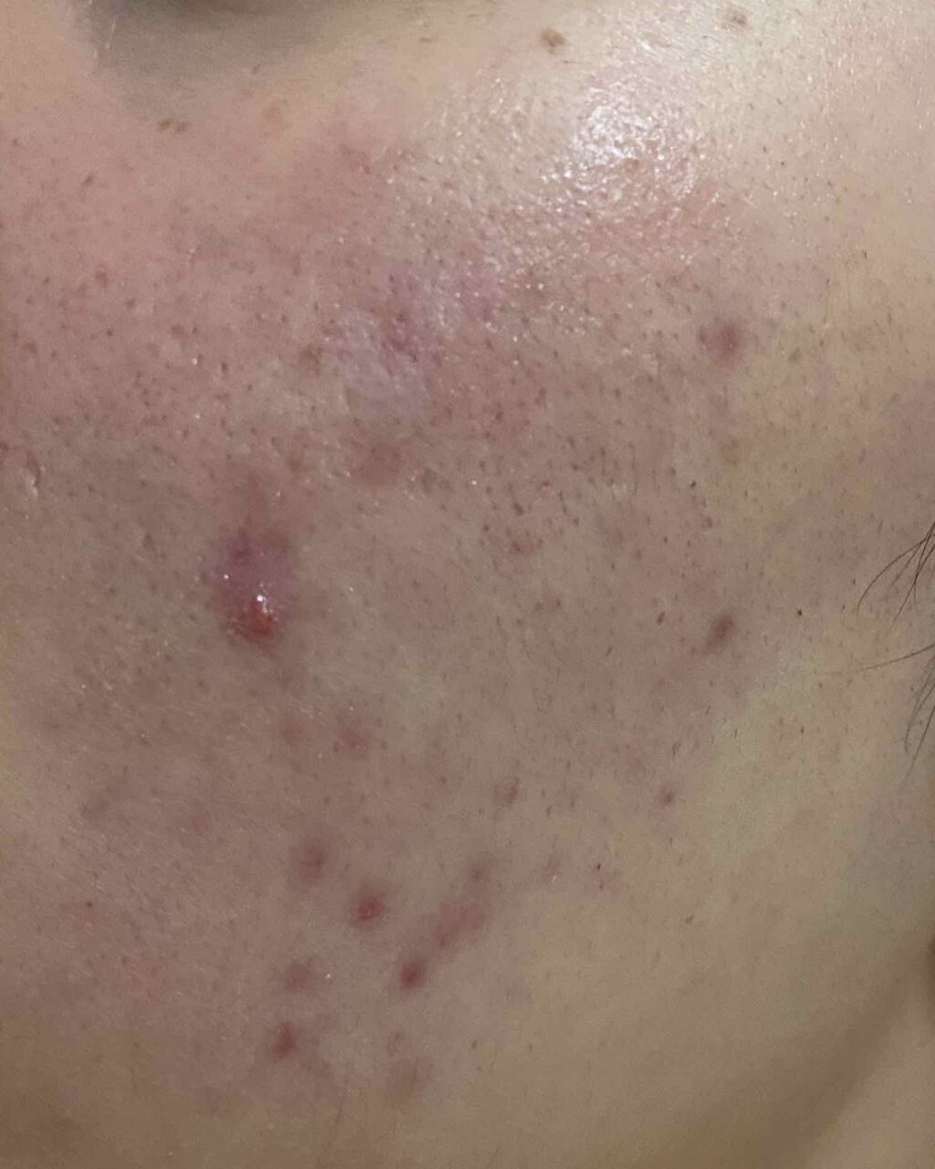 イオウカンフルローション(医薬品)/東豊薬品/その他を使ったクチコミ（3枚目）