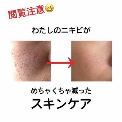 ペアアクネクリームW(医薬品)/ペア/その他を使ったクチコミ(1枚目)