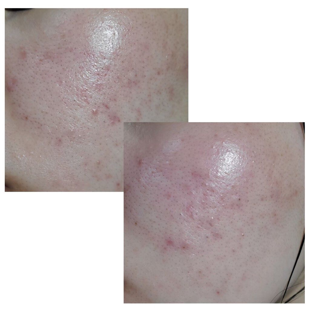 ぴい on LIPS 「私は、高校生からずっと肌荒れに悩んでいました。大学受験のストレ..」(2枚目)