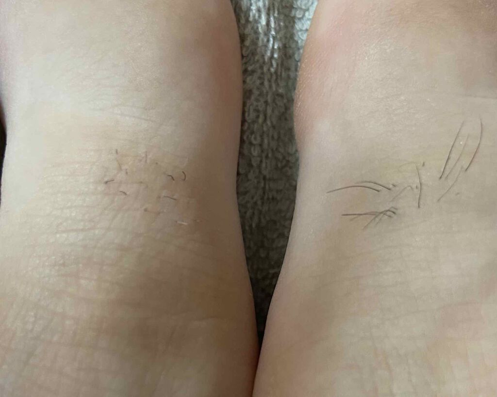 ブラウンシルクエキスパート (光美容器)/ブラウン/家庭用脱毛器を使ったクチコミ(2枚目)