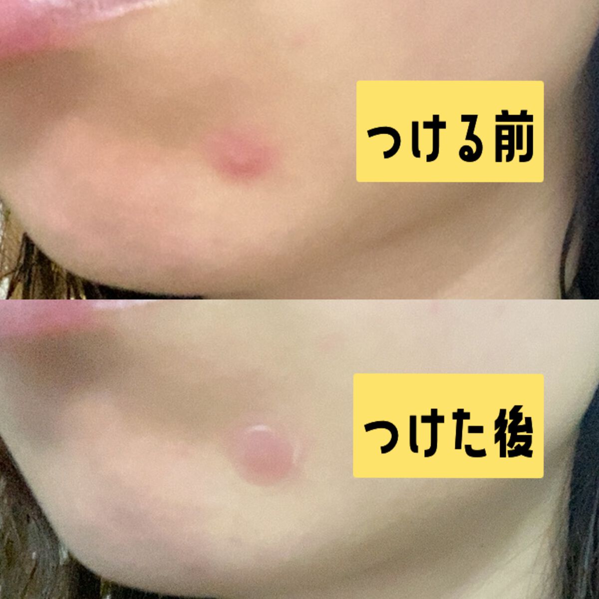 ゼロスポットパッチ/Today’s Cosme/にきびパッチを使ったクチコミ(4枚目)