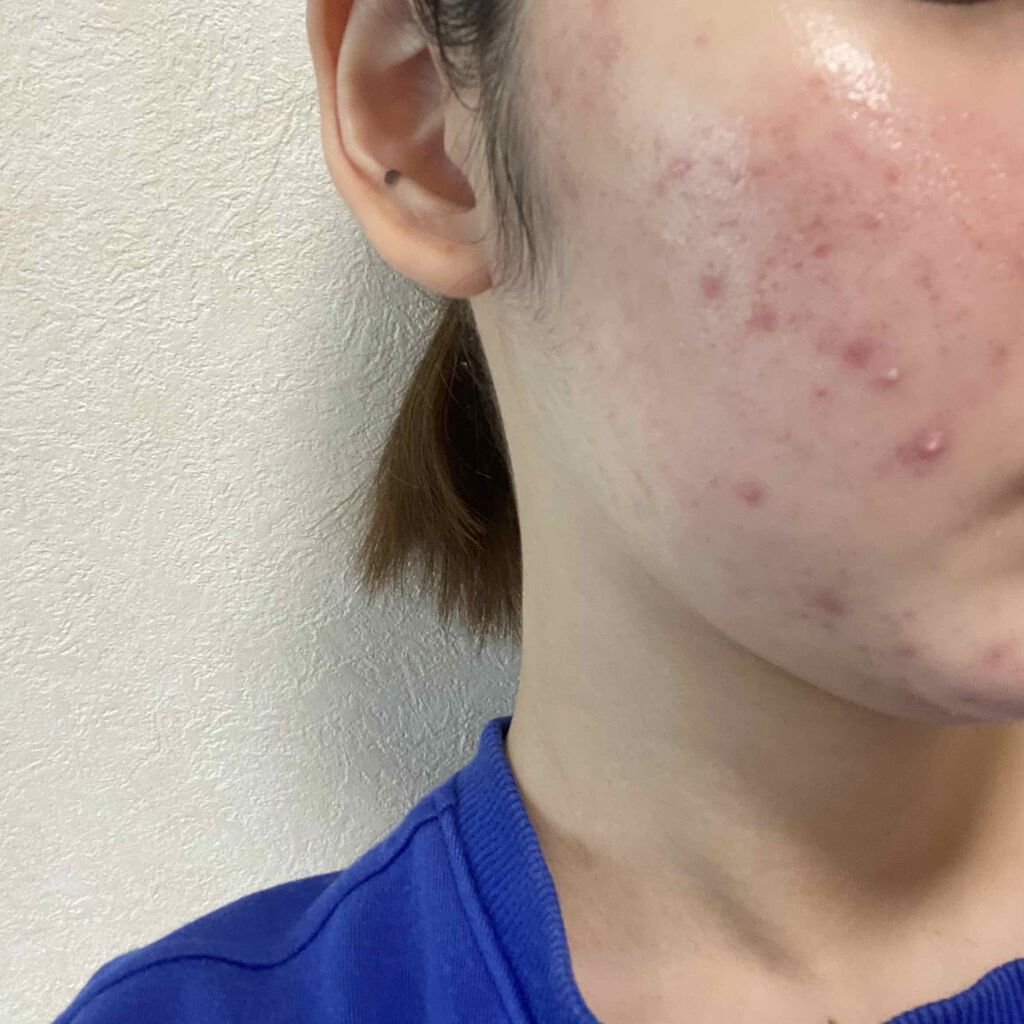 クリンダマイシンゲル(医薬品)/クラシエ薬品/その他を使ったクチコミ（1枚目）