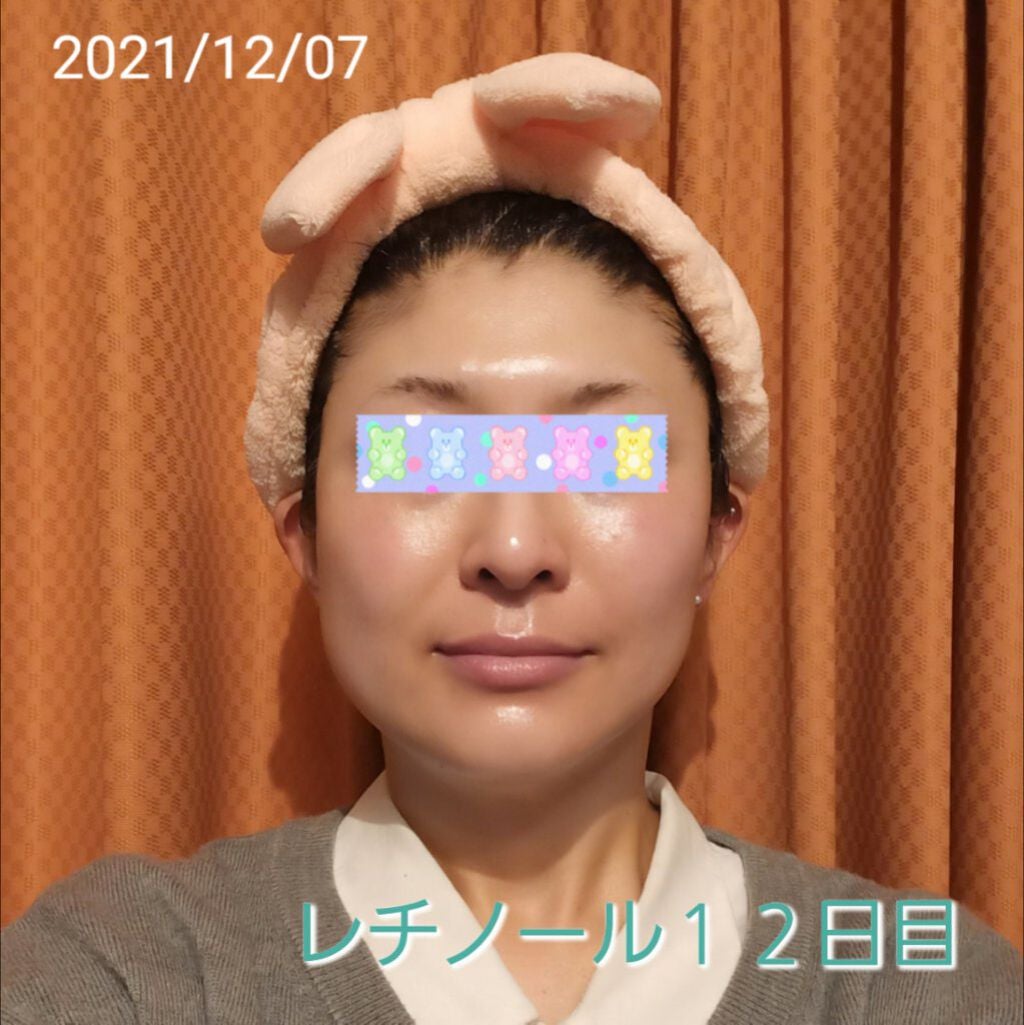 トレチノインジェル/A-Ret/美容液を使ったクチコミ(1枚目)