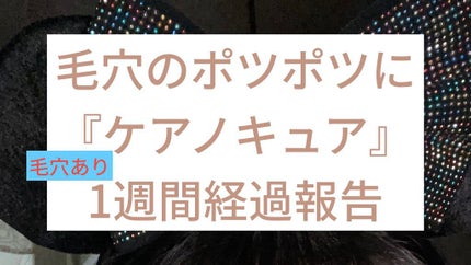 ケアノキュア(医薬品)/小林製薬/その他を使ったクチコミ(1枚目)