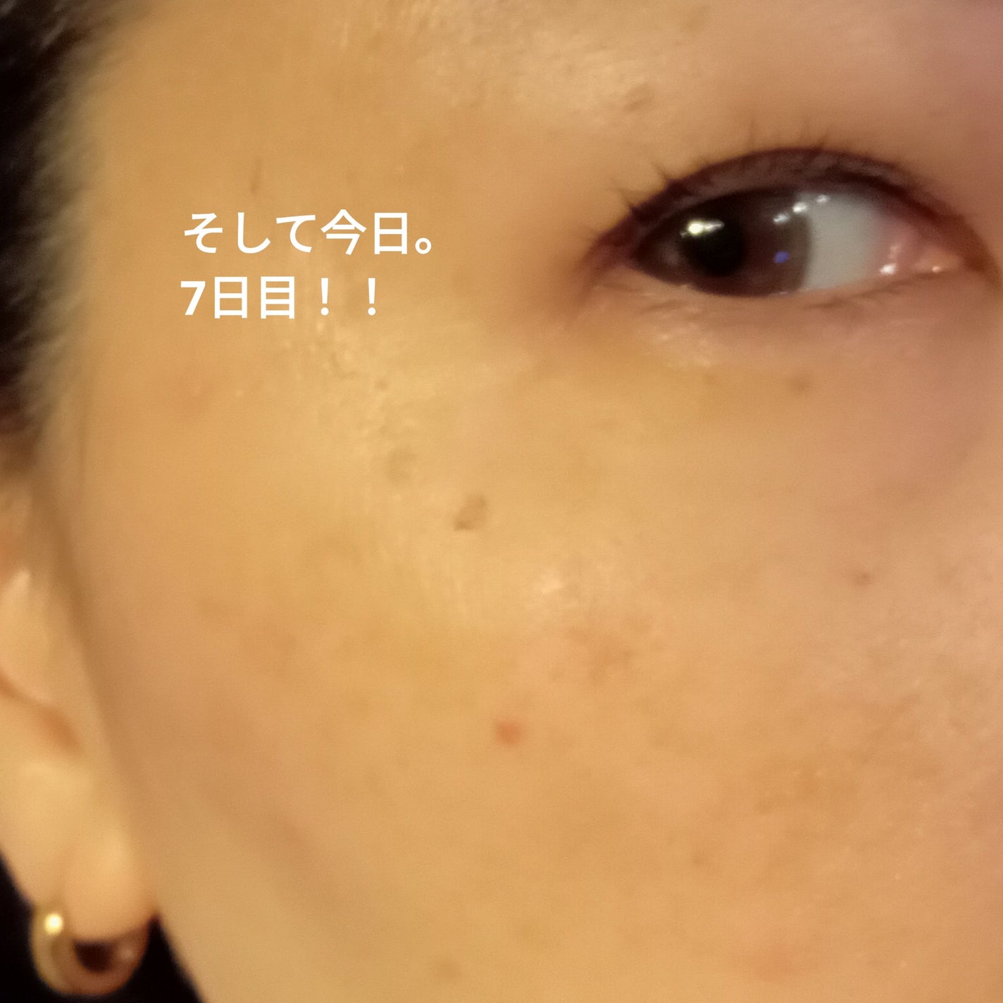 ビヨンセ奥二重向上委員長🥸LIPSパートナー🥳 on LIPS 「ついに!!この時が🤣🩷シミ取りレーザー全記録です🙌🙌🙌(五日目..」(9枚目)