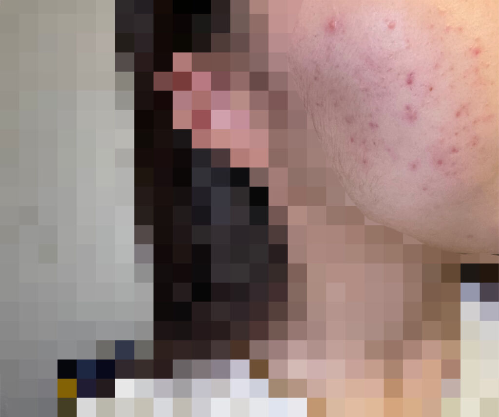 ニキビ治療薬(医薬品)/メンソレータム アクネス/その他を使ったクチコミ（3枚目）