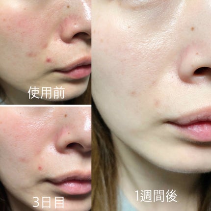 ゼロ毛穴パッド/MEDICUBE/ブースター・導入液を使ったクチコミ(4枚目)