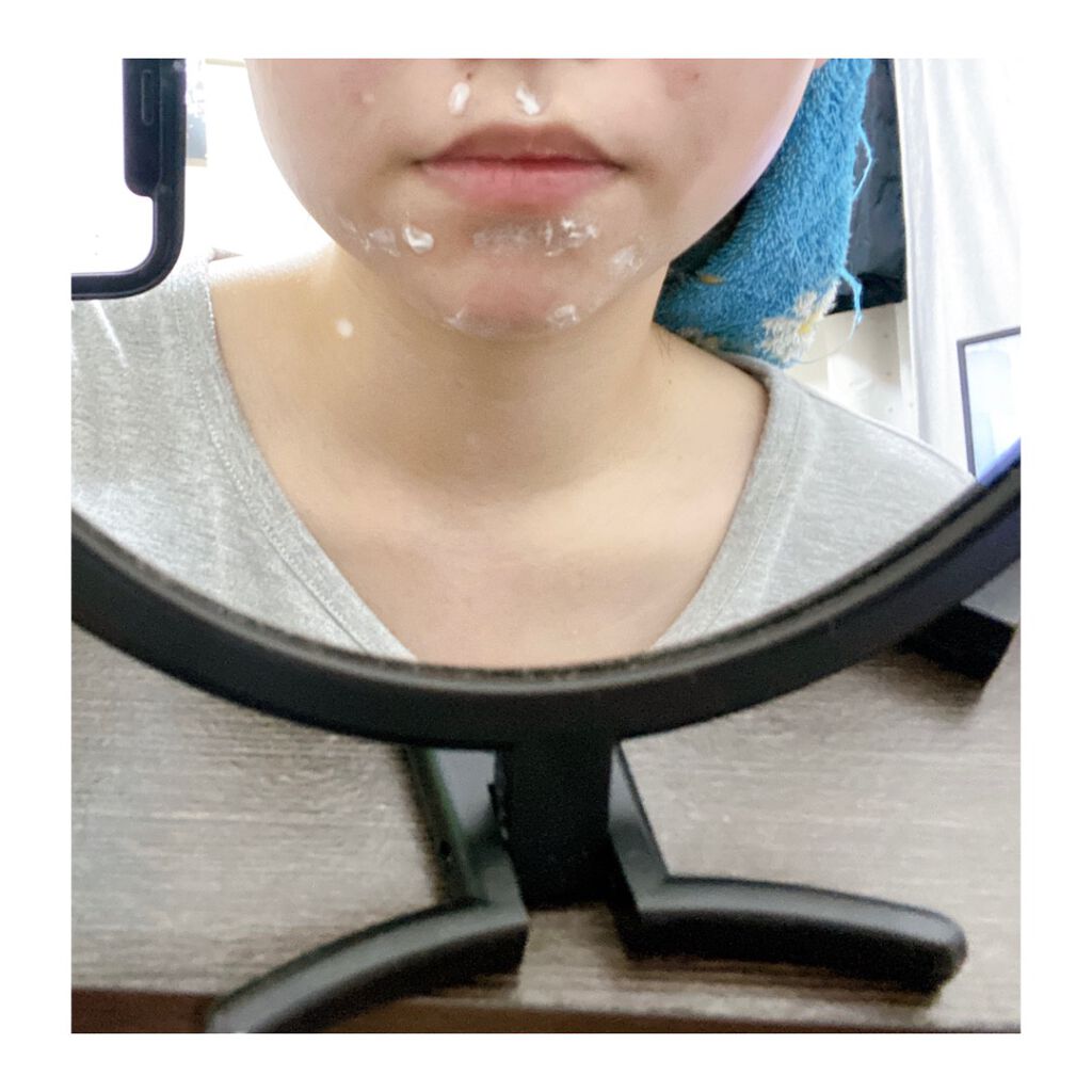 ペアアクネクリームW(医薬品)/ペア/その他を使ったクチコミ（2枚目）