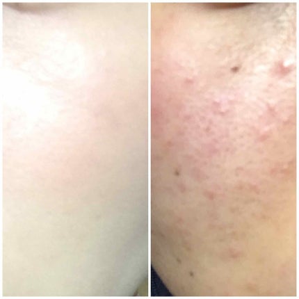 b.glen 7 day Special Set プログラム5のクチコミ「2年間何を試しても治らなかった
ニキビ肌が劇的に治ったので
皆さんと共有したいです!\( ˆo.....」(1枚目)