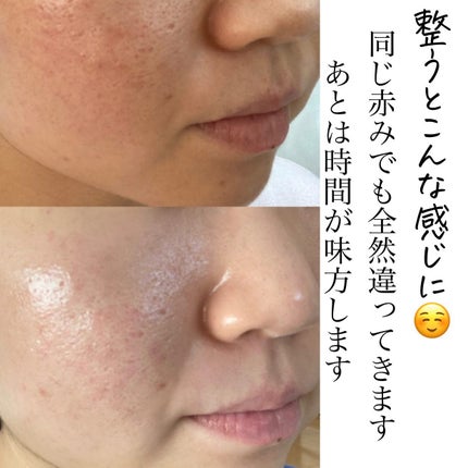 おゆみ|ニキビ・ニキビ跡ケア on LIPS 「【ニキビに効く化粧品なんてありません】こんばんは。24..」(5枚目)