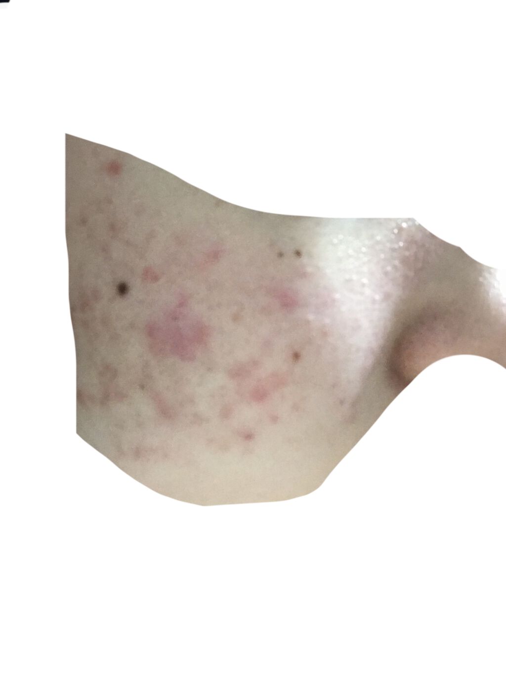 ベトネベートN軟膏AS(医薬品)/第一三共ヘルスケア/その他を使ったクチコミ（3枚目）