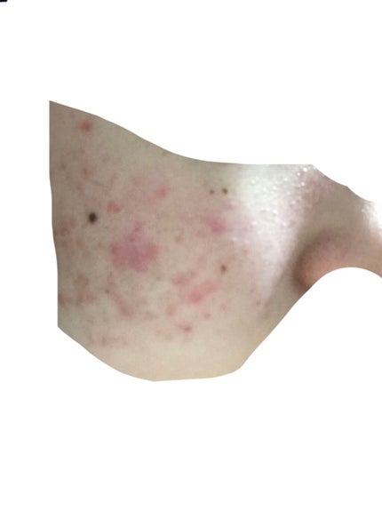 ベトネベートN軟膏AS(医薬品)/第一三共ヘルスケア/その他を使ったクチコミ(3枚目)