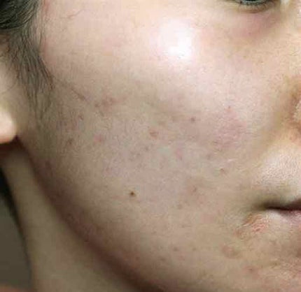 オードムーゲ 薬用ローション(ふきとり化粧水)/オードムーゲ/拭き取り化粧水を使ったクチコミ(1枚目)