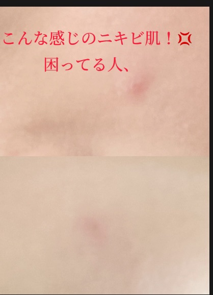 ダーマレーザー ウルセラC/クオリティファースト/美容液を使ったクチコミ（1枚目）