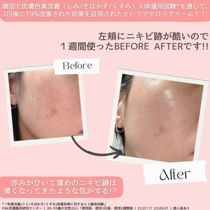 パルマーズ シミ色素沈着 ニキビ跡解消 肌のトーン改善クリーム アセロラダークスポット&ブレミッシュ ケア クリーム|RAVIELの