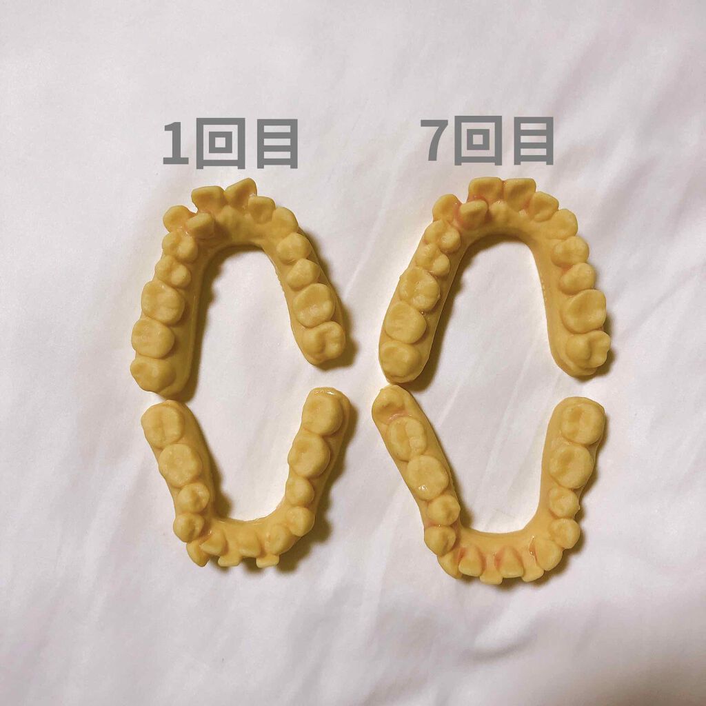 マウスピース矯正/その他を使ったクチコミ（3枚目）